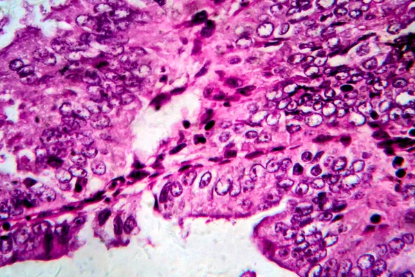 Endometrial adenocarcinoma, light micrograph — Stock Photo, Image