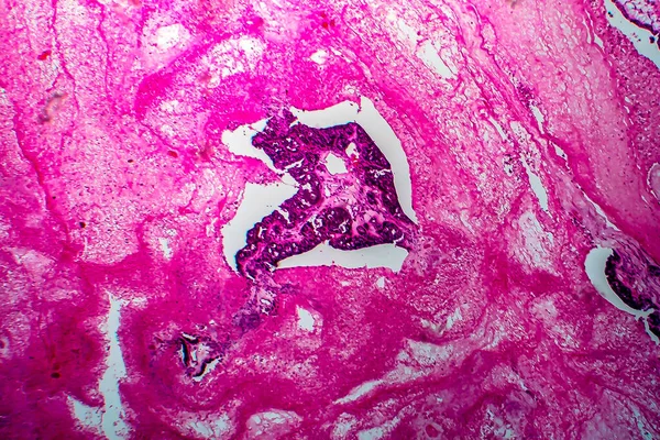 Papiller seröz yumurtalık adenokarsinom, hafif mikrograf. — Stok fotoğraf