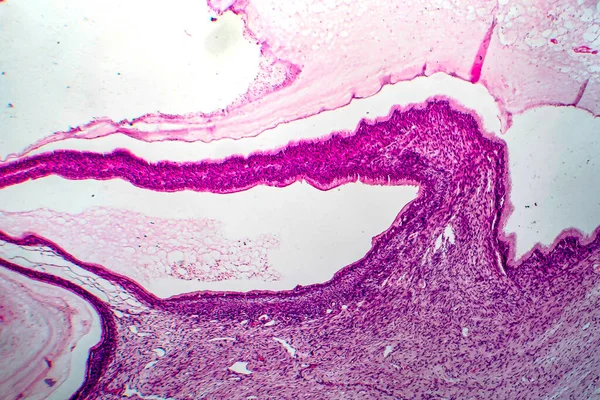 Ovarian mucinous cystadenoma, a benign tumor of ovary, light micrograph, photo under microscope