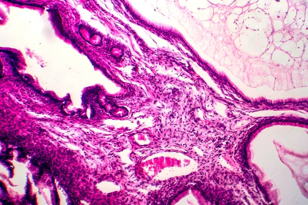 Citadenoma Mucinoso Ovárico Tumor Benigno Ovario Micrografía Ligera Foto Bajo — Foto de Stock