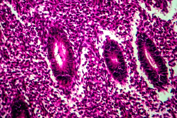子宫内膜增生 显微镜下照片 — 图库照片