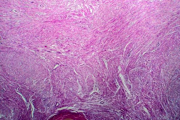 子宫肌瘤 又称纤维瘤 子宫平滑肌良性肿瘤 光镜下摄影 — 图库照片