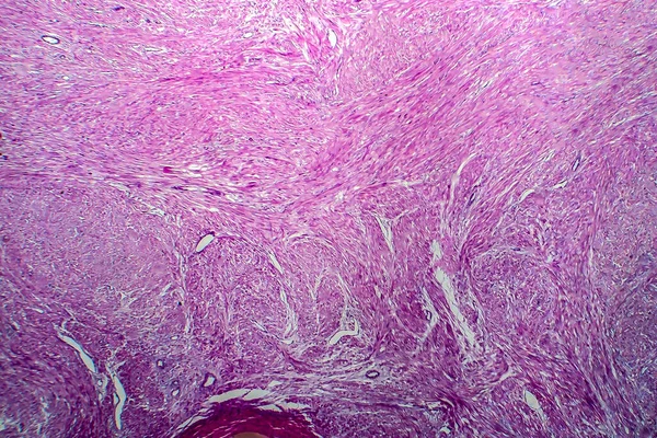 Méh Leiomyoma Más Néven Mióma Jóindulatú Simaizom Tumor Méh Fény — Stock Fotó