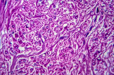 Rahim leyomu, fibroid olarak da bilinir rahmin iyi huylu kas tümörü, ışık mikrografı, mikroskop altında fotoğraf.