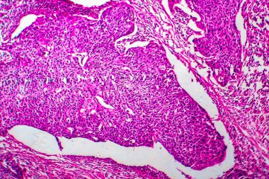 Rahmin skuamöz hücre kanseri, hafif mikrograf, mikroskop altında fotoğraf.