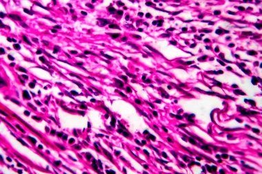 Rahmin skuamöz hücre kanseri, hafif mikrograf, mikroskop altında fotoğraf.