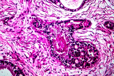 Rahim kanseri, ışık mikrografı, mikroskop altında fotoğraf.