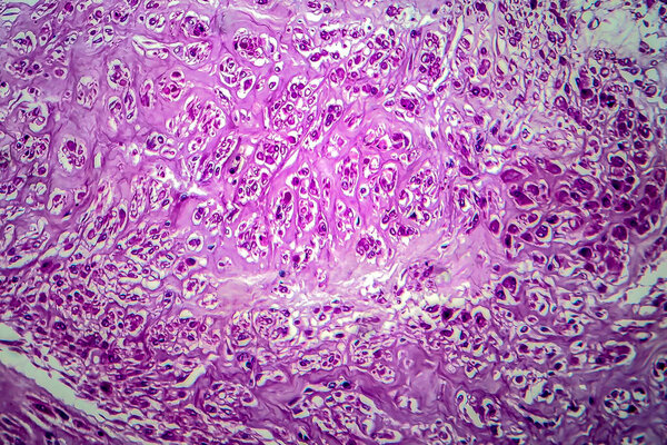 Uterine leiomyoma, also known as fibroids,a benign smooth muscle tumor of the uterus, light micrograph, photo under microscope