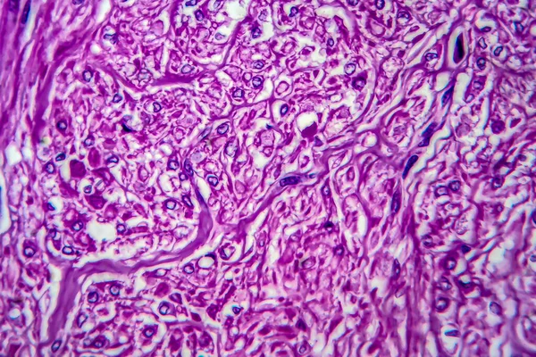 Leiomioma Uterino Noto Anche Come Fibromi Tumore Benigno Della Muscolatura — Foto Stock