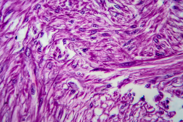 Uterine leiomyoma, also known as fibroids,a benign smooth muscle tumor of the uterus, light micrograph, photo under microscope