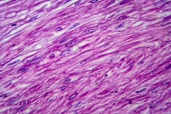 Uterine leiomyoma, also known as fibroids,a benign smooth muscle tumor of the uterus, light micrograph, photo under microscope
