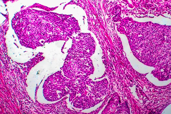 Carcinoma Espinocelular Útero Micrografia Luz Foto Sob Microscópio — Fotografia de Stock