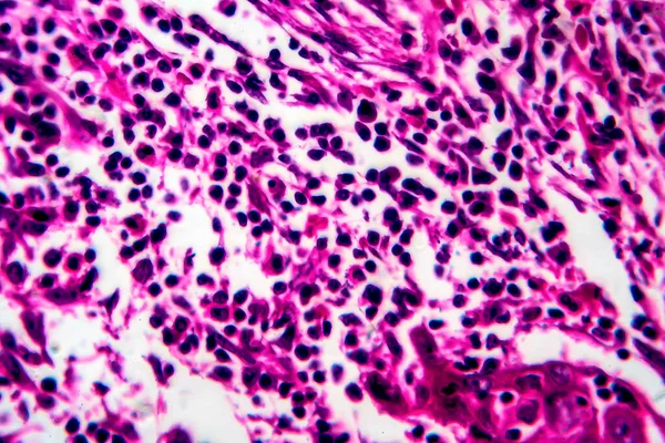 Carcinoma Espinocelular Útero Micrografia Luz Foto Sob Microscópio — Fotografia de Stock