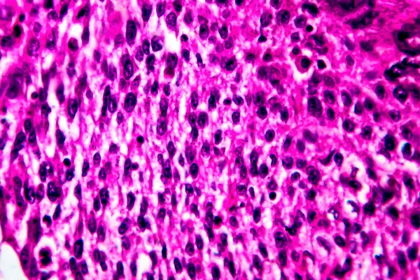 Плоскоклеточный Рак Матки Световой Микрограф Фото Микроскопом — стоковое фото