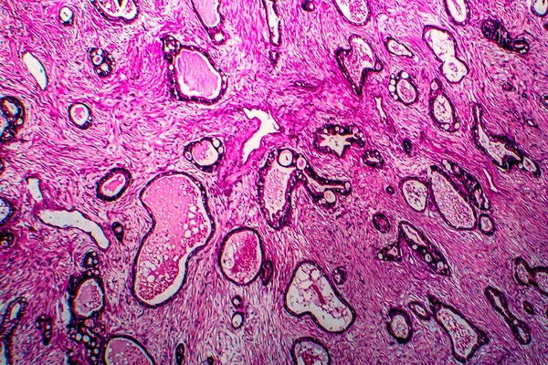子宮がん 軽いマイクログラフ 顕微鏡下の写真 — ストック写真