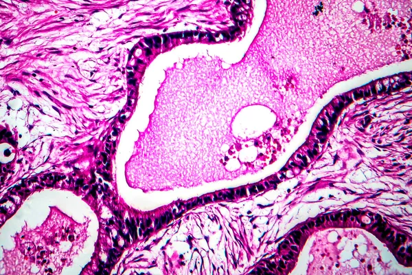 Cáncer Uterino Micrografía Ligera Foto Bajo Microscopio —  Fotos de Stock