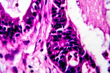 Rahim kanseri, ışık mikrografı, mikroskop altında fotoğraf.