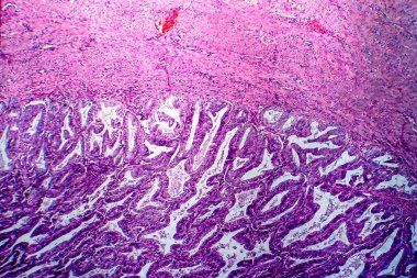 Endometrial adenocarcinoma, light micrograph, photo under microscope clipart
