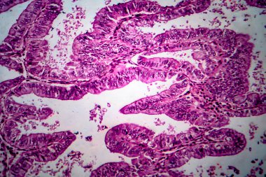 Endometriyal adenokarsinom, hafif mikrograf, mikroskop altında fotoğraf.