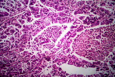 Endometriyal adenokarsinom, hafif mikrograf, mikroskop altında fotoğraf.