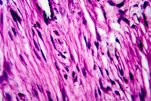 Cáncer Uterino Micrografía Ligera Foto Bajo Microscopio — Foto de Stock