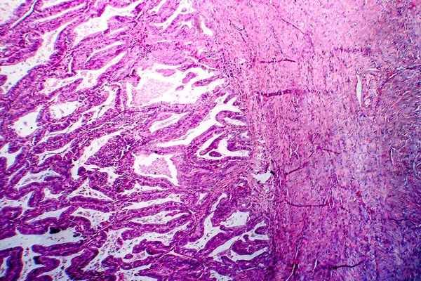 Gruczolakorak Endometrium Mikrograf Świetlny Zdjęcie Pod Mikroskopem — Zdjęcie stockowe