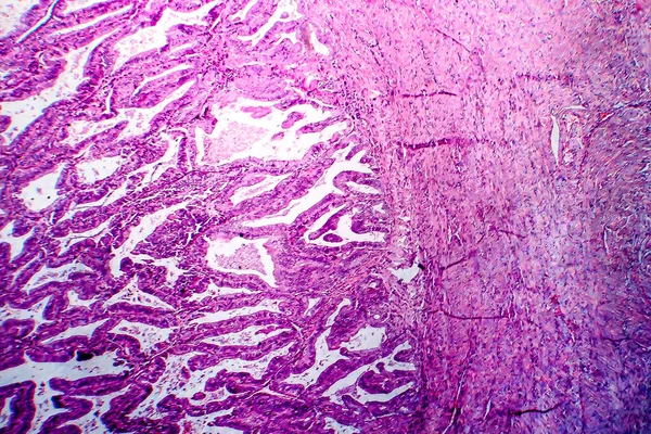 Adenocarcinoma Endometriale Microscopio Luce Foto Microscopio — Foto Stock