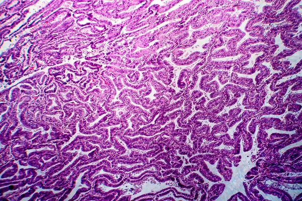 Adenocarcinoma Endometrio Micrografía Ligera Foto Bajo Microscopio —  Fotos de Stock