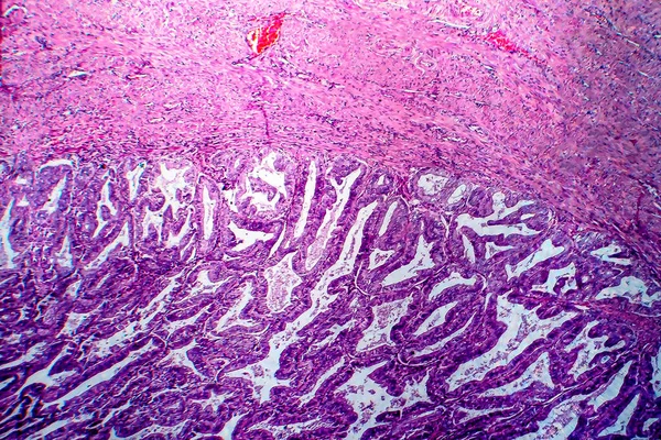 Endometriumadenocarcinoom Lichtmicrograaf Foto Onder Microscoop — Stockfoto