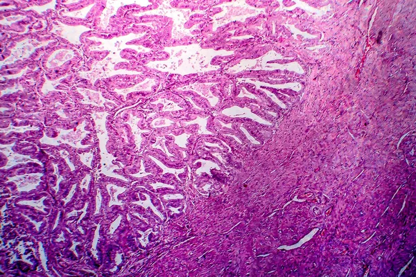 Endometriyal Adenokarsinom Hafif Mikrograf Mikroskop Altında Fotoğraf — Stok fotoğraf