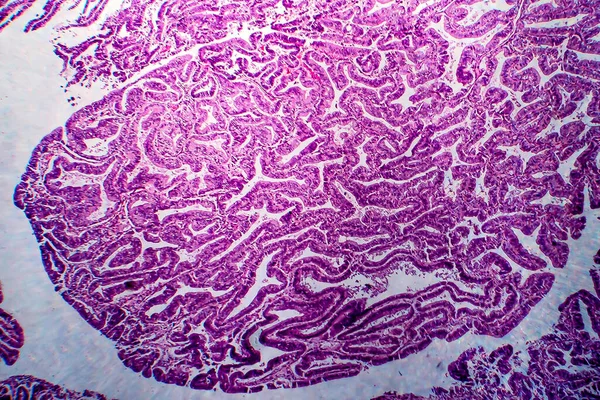 Adenocarcinom Endometrial Micrograf Luminos Fotografie Sub Microscop — Fotografie, imagine de stoc