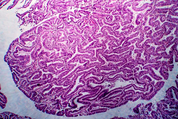 Adenocarcinoma Endometrio Micrografía Ligera Foto Bajo Microscopio —  Fotos de Stock