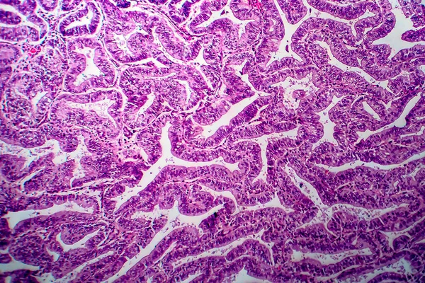 Adenocarcinoma Endometrio Micrografía Ligera Foto Bajo Microscopio —  Fotos de Stock