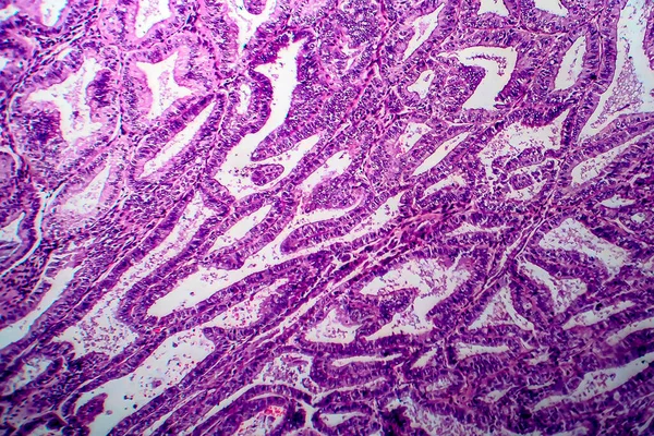 Adenocarcinoma Endometrio Micrografía Ligera Foto Bajo Microscopio —  Fotos de Stock