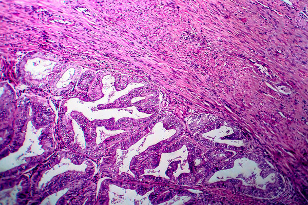 Endometrial adenocarcinoma, light micrograph, photo under microscope