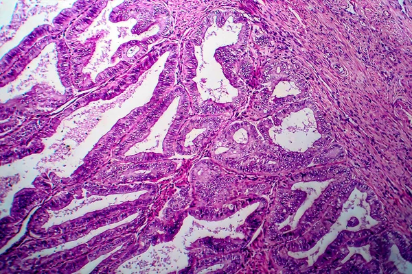 Adenocarcinoma Endométrio Micrografia Luz Foto Sob Microscópio — Fotografia de Stock