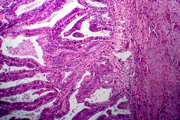 Endometrium Adenocarcinoma Fénymikrográf Fénykép Mikroszkóp Alatt — Stock Fotó