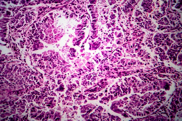 Endometrium Adenocarcinoma Fénymikrográf Fénykép Mikroszkóp Alatt — Stock Fotó