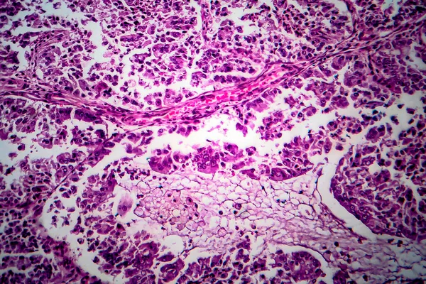 Endometriyal Adenokarsinom Hafif Mikrograf Mikroskop Altında Fotoğraf — Stok fotoğraf