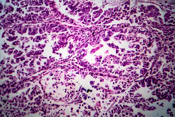 Adenocarcinoma Endométrio Micrografia Luz Foto Sob Microscópio — Fotografia de Stock