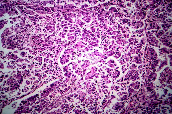 Adenocarcinoma Endométrio Micrografia Luz Foto Sob Microscópio — Fotografia de Stock