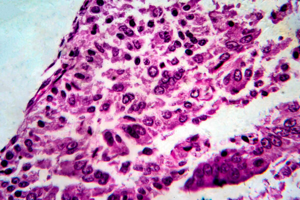 Endometrial adenocarcinoma, light micrograph, photo under microscope