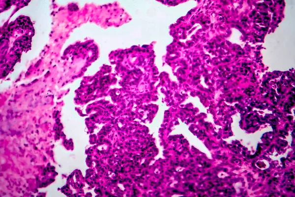 Papillares Seröses Ovarielles Adenokarzinom Eierstockkrebs Lichtmikroskopie Foto Unter Dem Mikroskop — Stockfoto