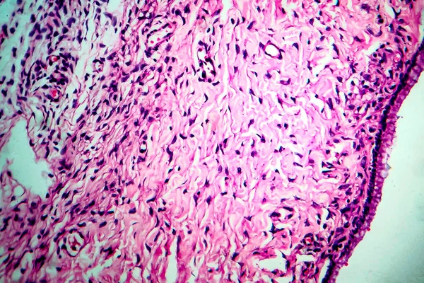 Ovariální Cysta Světelný Mikrograf Fotografie Pod Mikroskopem — Stock fotografie