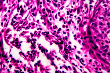 Rahmin skuamöz hücre kanseri, hafif mikrograf, mikroskop altında fotoğraf.