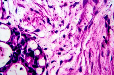 Rahim kanseri, ışık mikrografı, mikroskop altında fotoğraf.