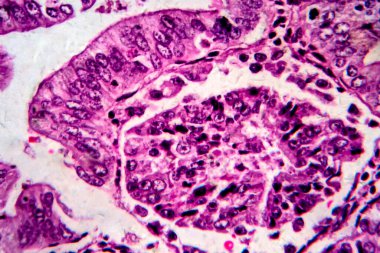 Endometriyal adenokarsinom, hafif mikrograf, mikroskop altında fotoğraf.