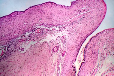 Ovarian cyst, light micrograph, photo under microscope clipart