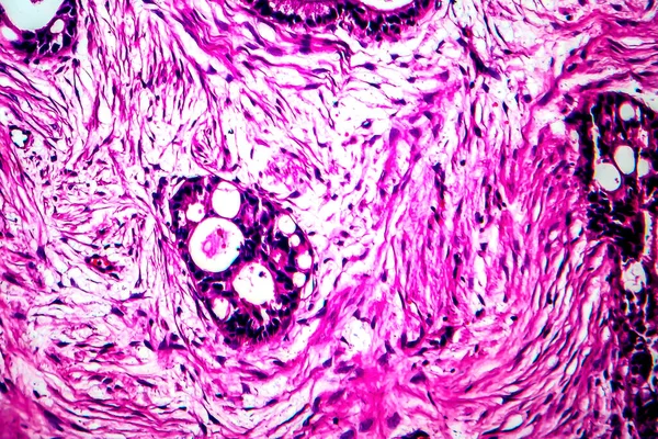 Rak Macicy Mikrograf Świetlny Zdjęcie Pod Mikroskopem — Zdjęcie stockowe