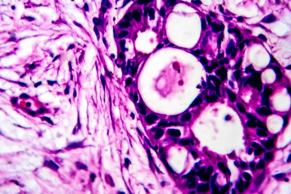 Uteriene Kanker Lichtmicrograaf Foto Onder Microscoop — Stockfoto